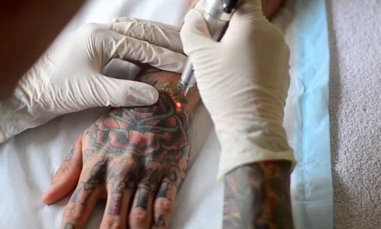 Το κορυφαίο laser αφαίρεσης τατουάζ τώρα και στην Ελλάδα
